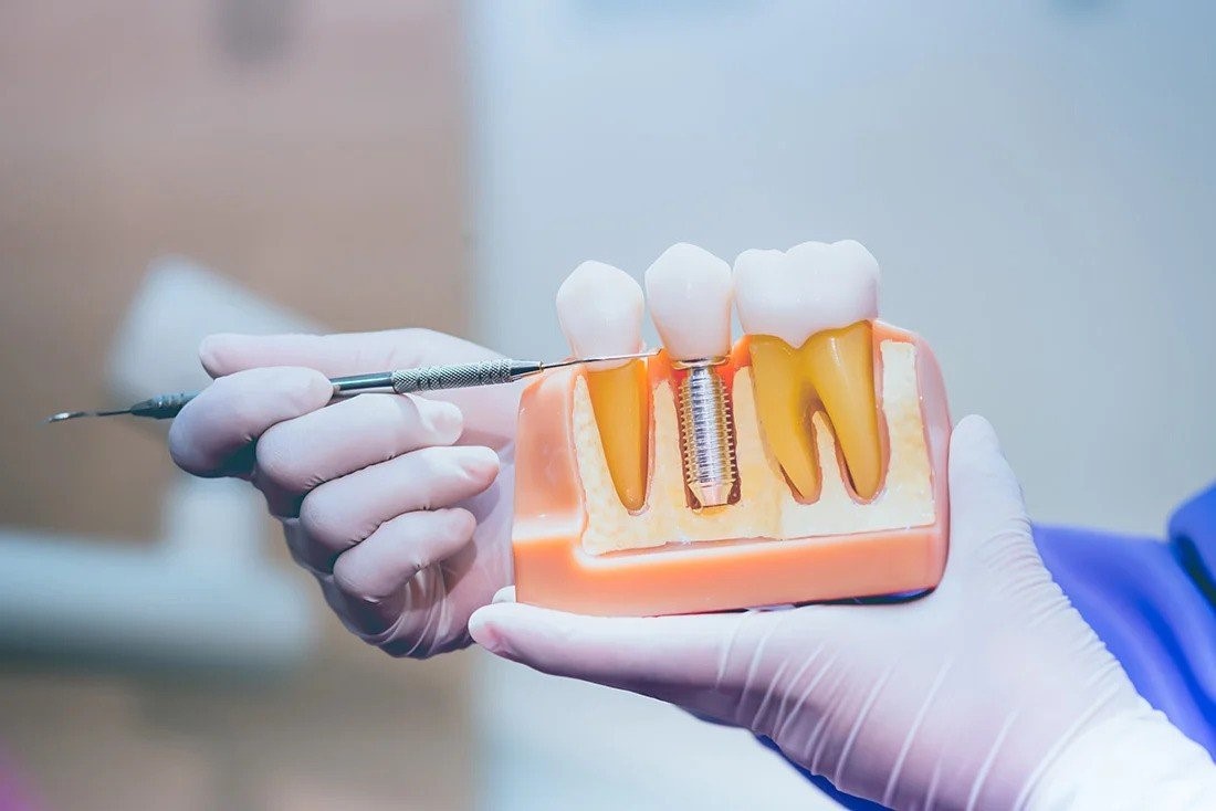 تفاوت های بین متخصص ایمپلنت و دندانپزشک عمومی